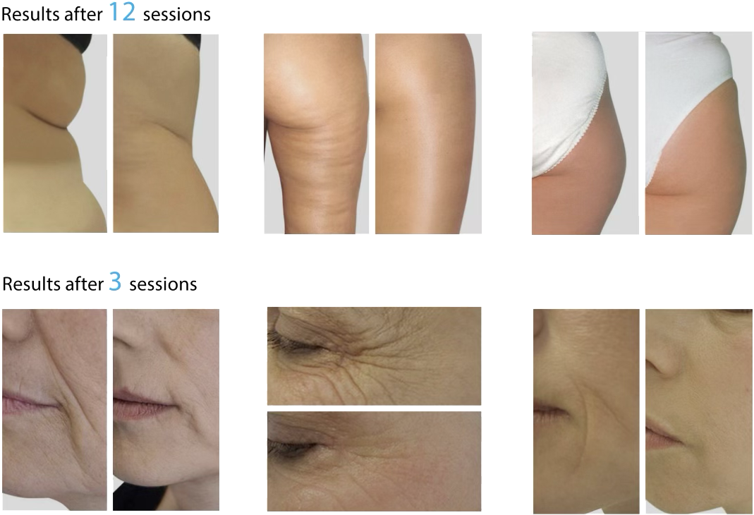 endospheres-before-after-luxbae-med-spa-glendale